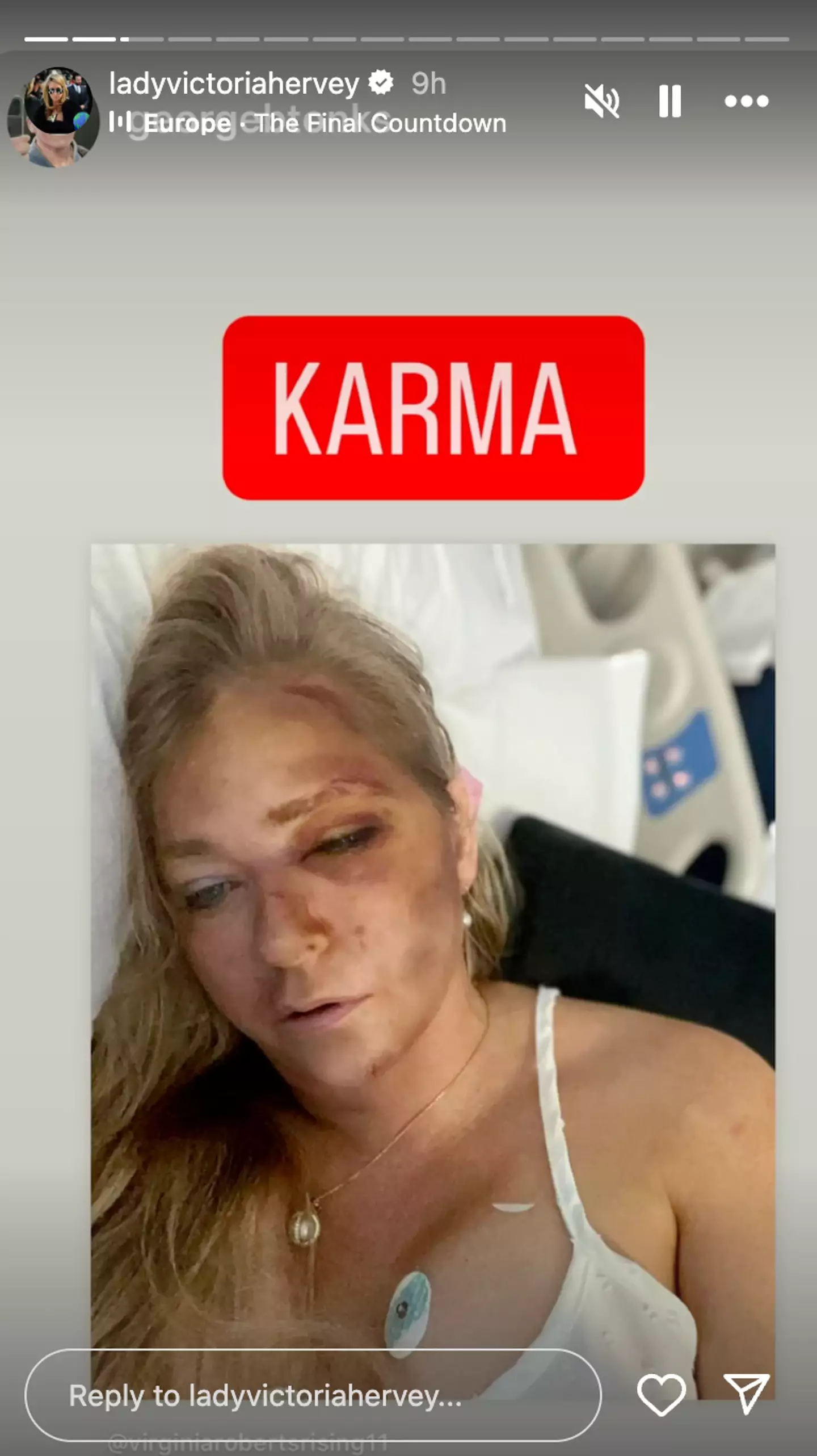 Hervey re-posted Giuffre's photo of her facial injuries with the words 'KARMA' plastered over it (Instagram/@ladyvictoriahervey)