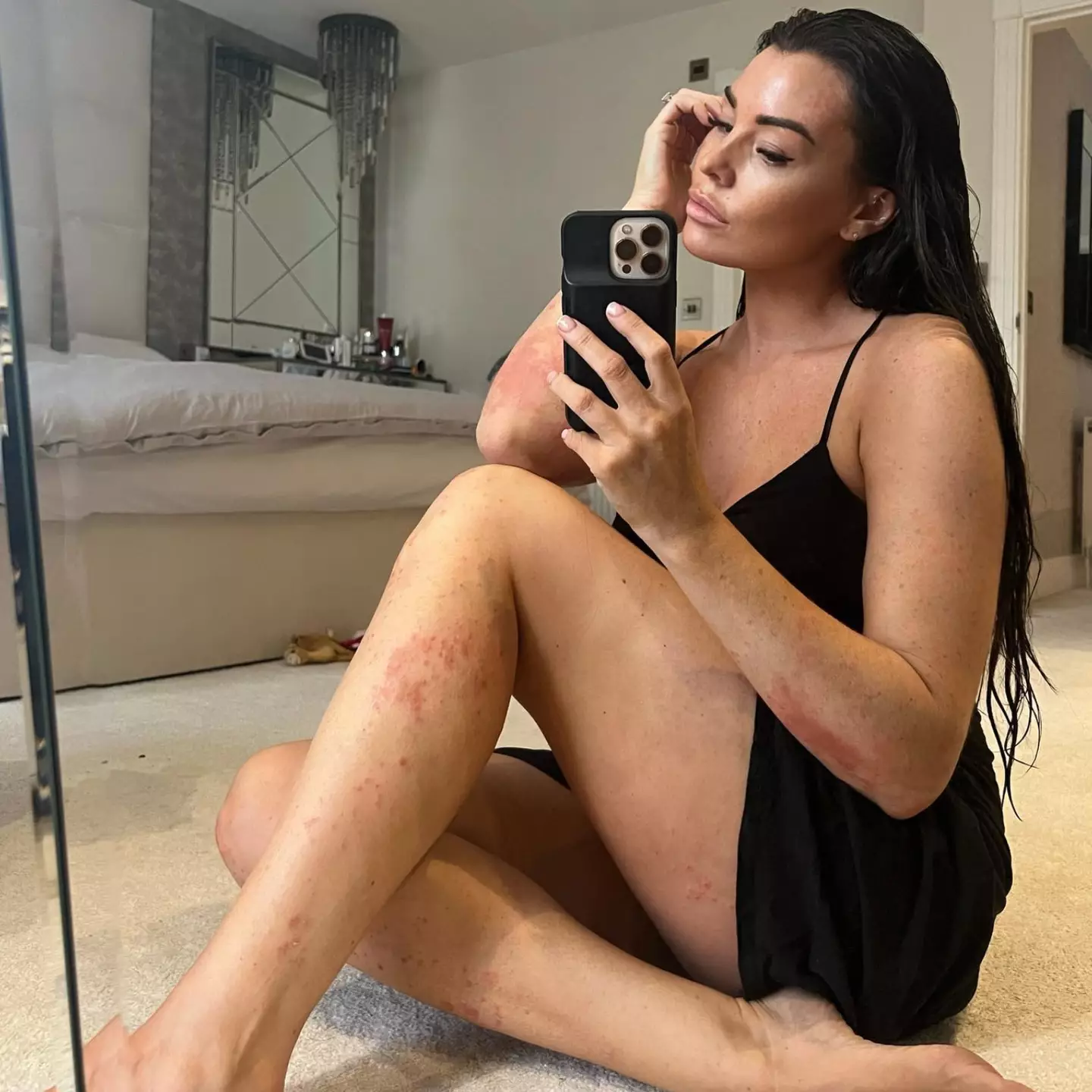 Jess Wright shared a post to mark Psoriasis Awareness Month.
