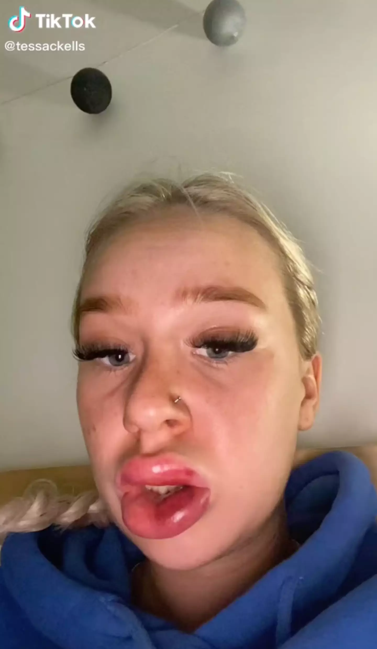 Sometimes lip filler can go dramatically wrong.