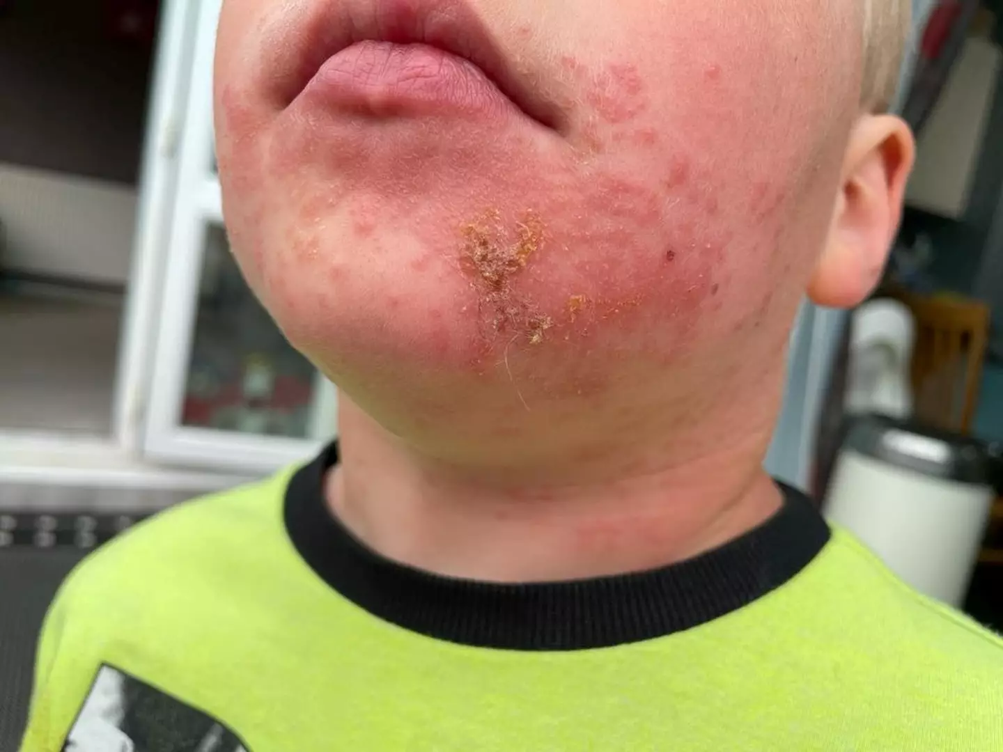 A mum has issued a warning to other parents after her toddler developed a severe rash (