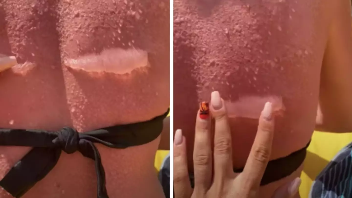 Woman's Horrific Sunburn Reminds Us Why Sun Protection Is Essential