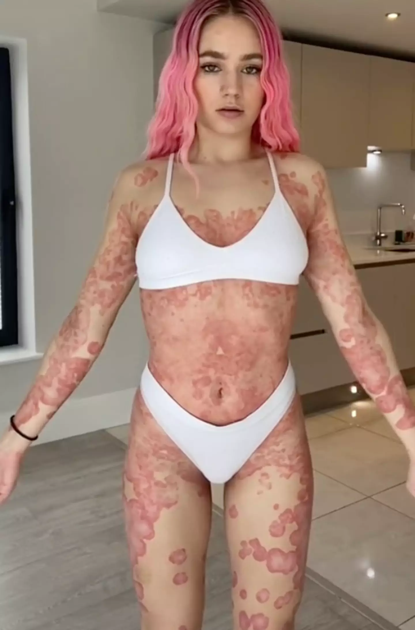 Rosie's psoriasis covered 90 per cent of her body.