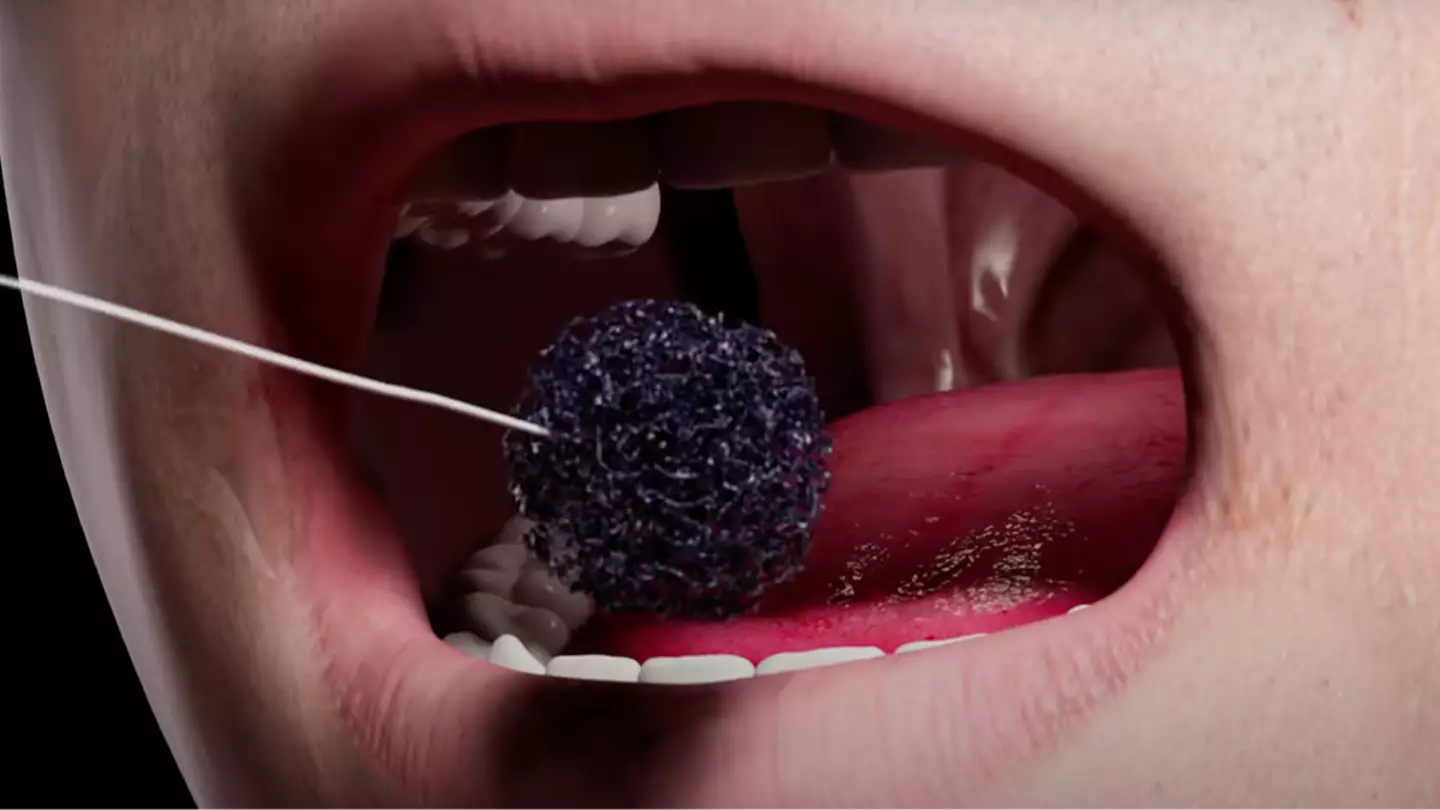 Simple sponge test can help find cancer 'hiding in plain sight' as symptoms often mistaken for indigestion