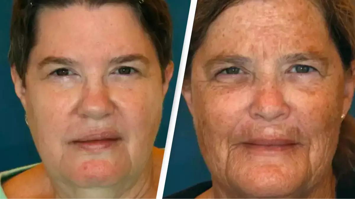 American Society of Plastic Surgeons / Dr. Bahman Guyuron