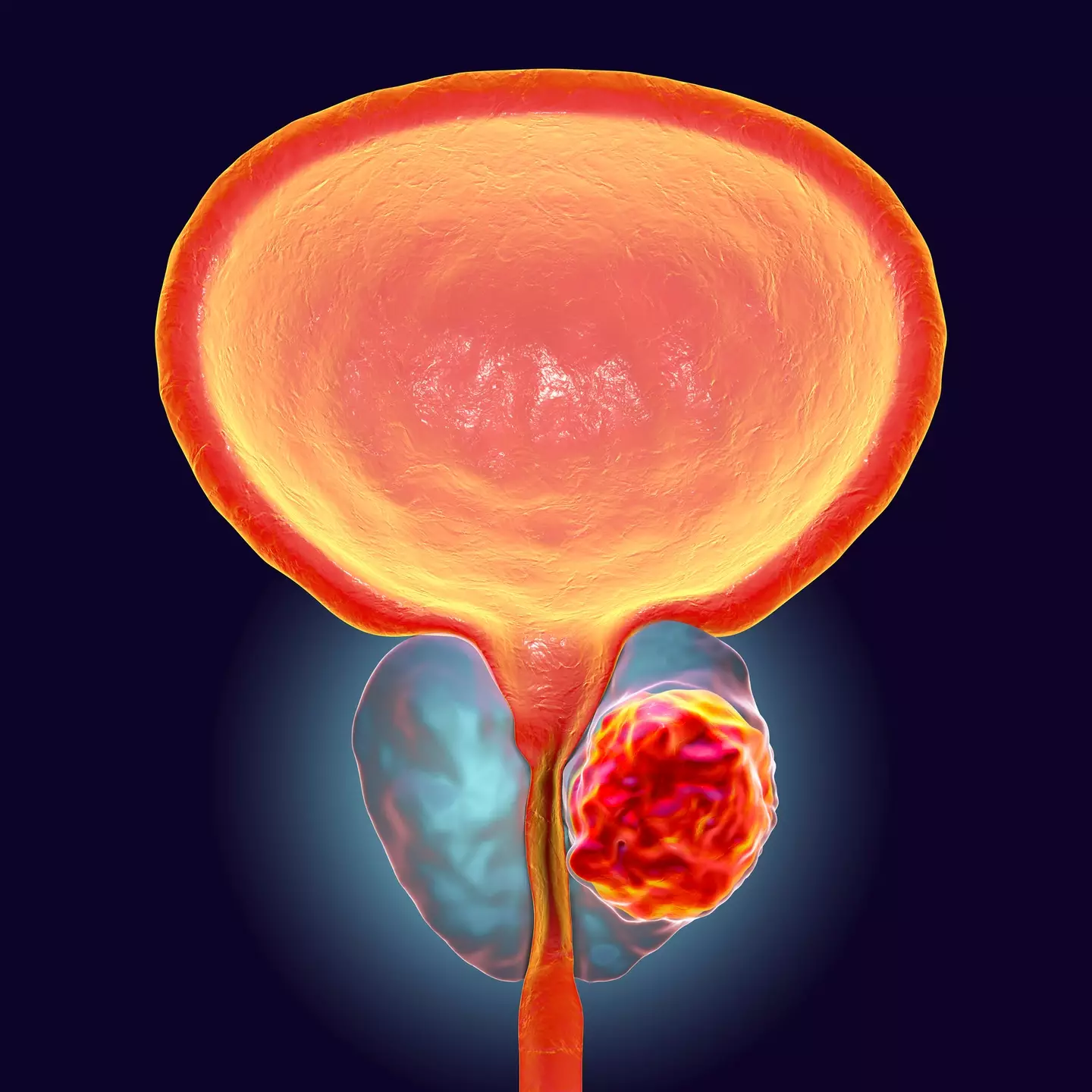 A tumour inside the prostate gland, which compresses urethra (Kateryna Kon/Science Photo Library/Getty Images)