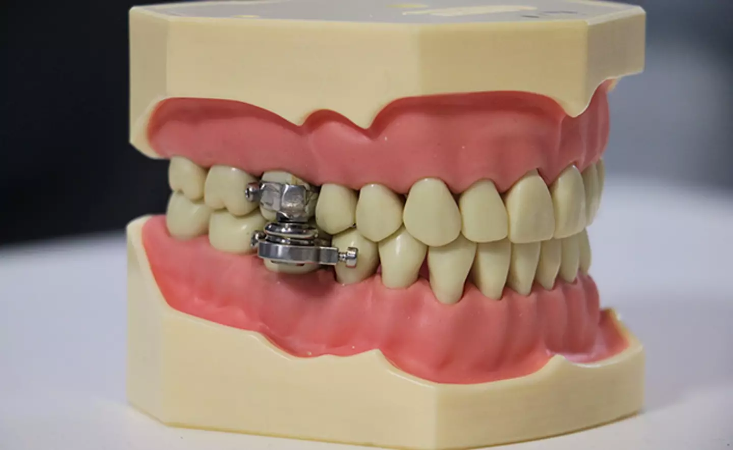 Scientists have invented a 'weight-loss' device that sees the user's jaw locked shut. (University of Otago)