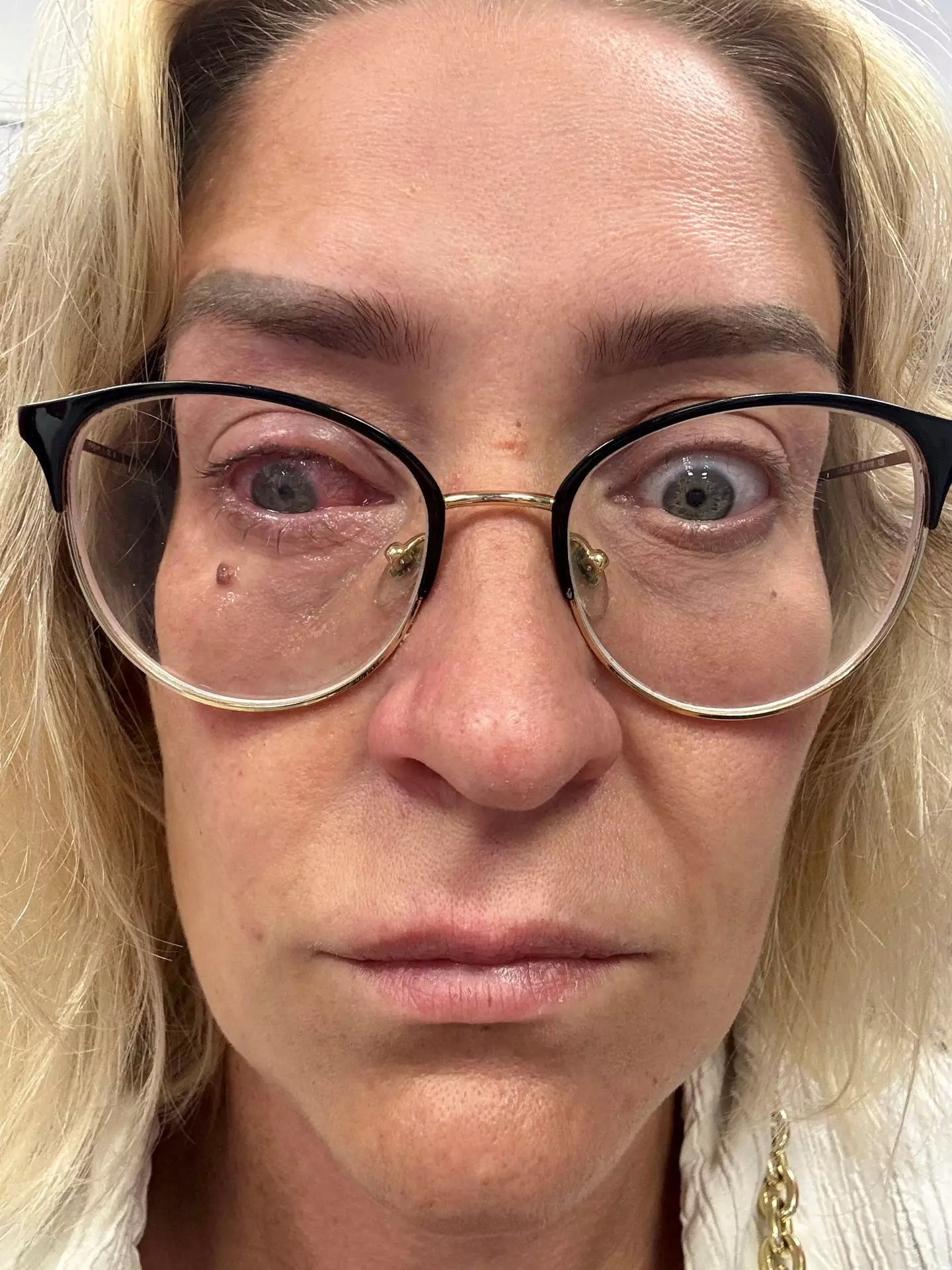 Katie lost the vision in her right eye (SWNS)