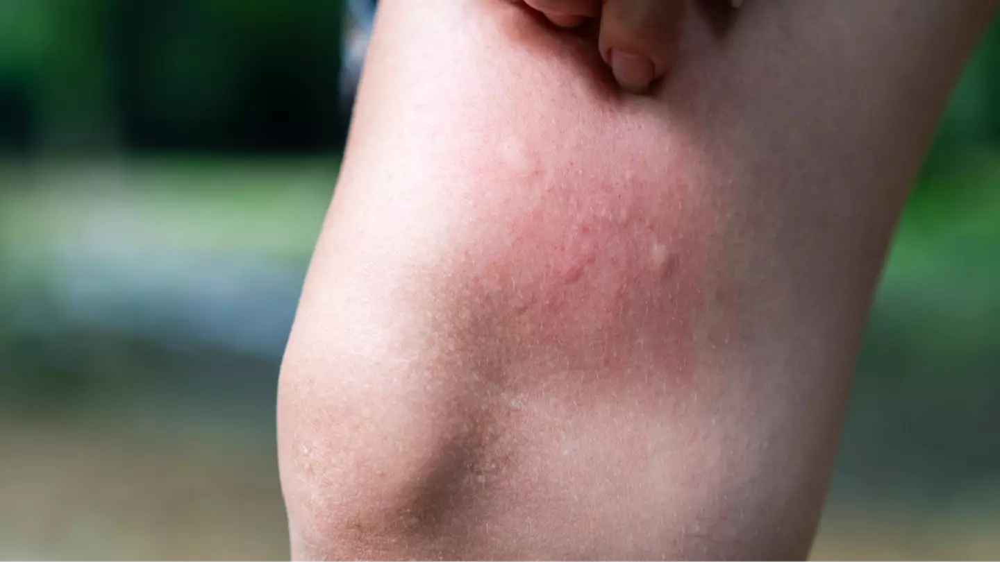 Mom, 33, issues warning after noticing ‘mosquito bite’ that turned out to be much more sinister