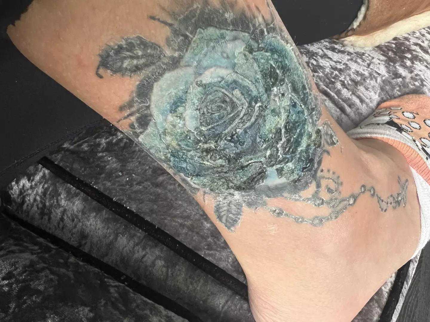 Griffiths' tattoo began to blister and fluid seeped out, the mom explained (Kennedy News and Media)