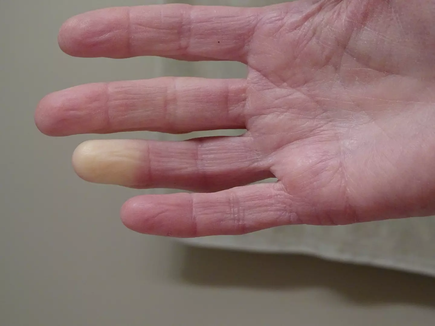 Raynaud's symptoms can be prevented by attempting to keep warm (Getty Stock Photo)