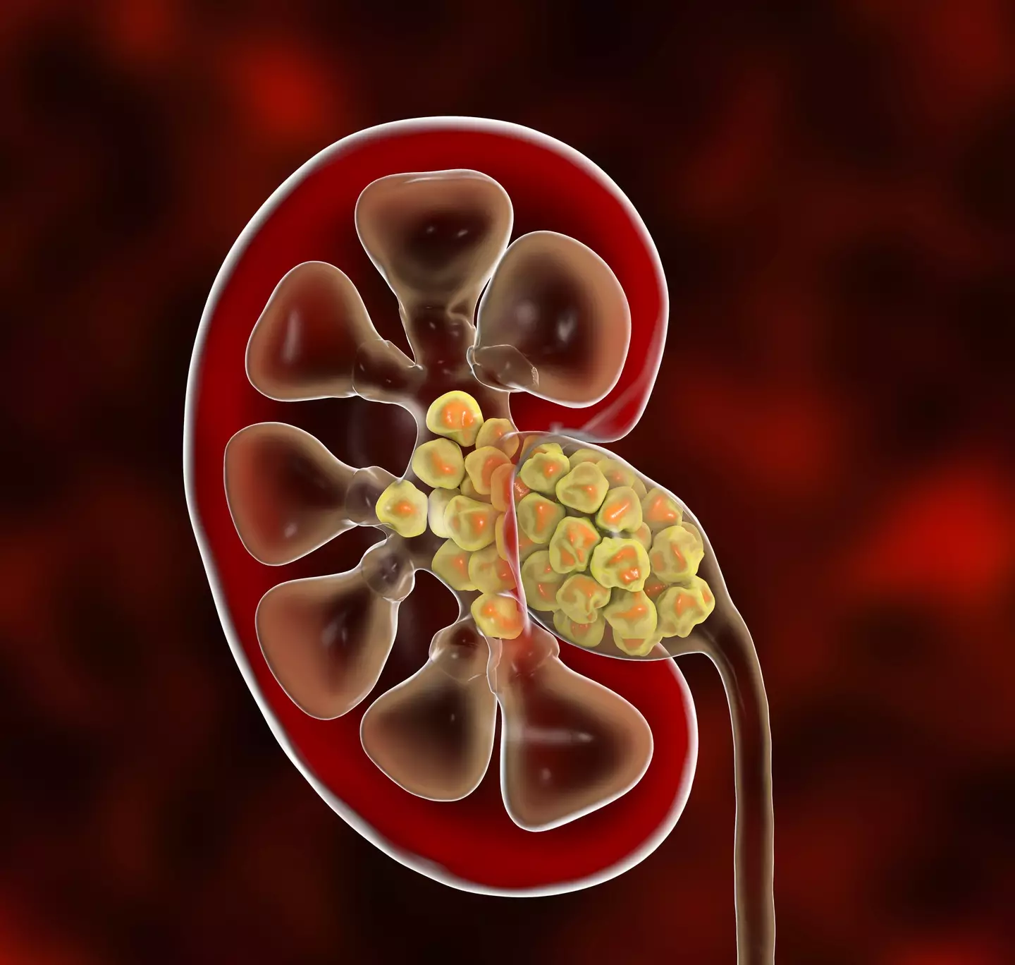 Kidney stones are the worst natural pain a human can experience (Getty stock)