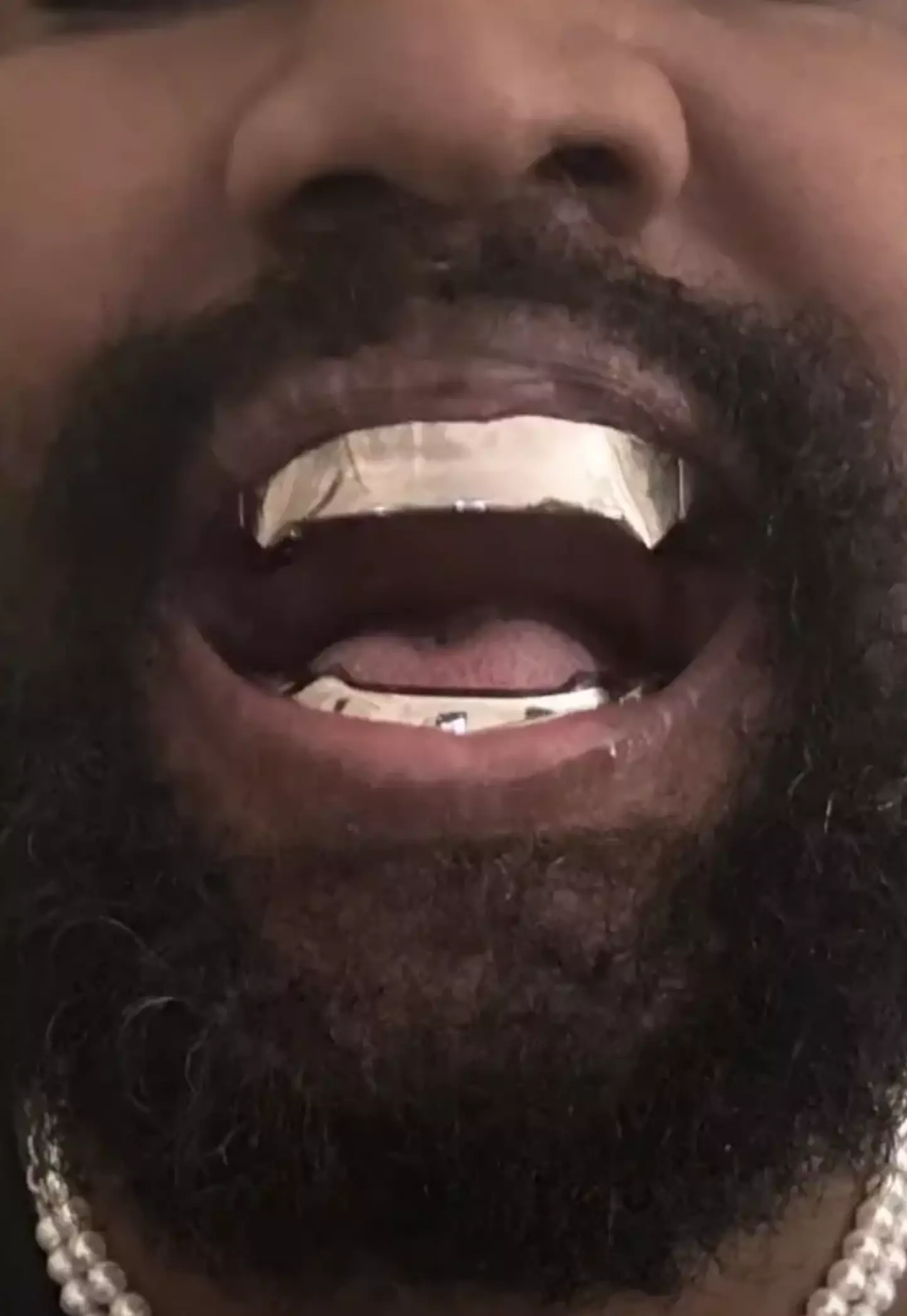 Ye showed off the dentures on Instagram.