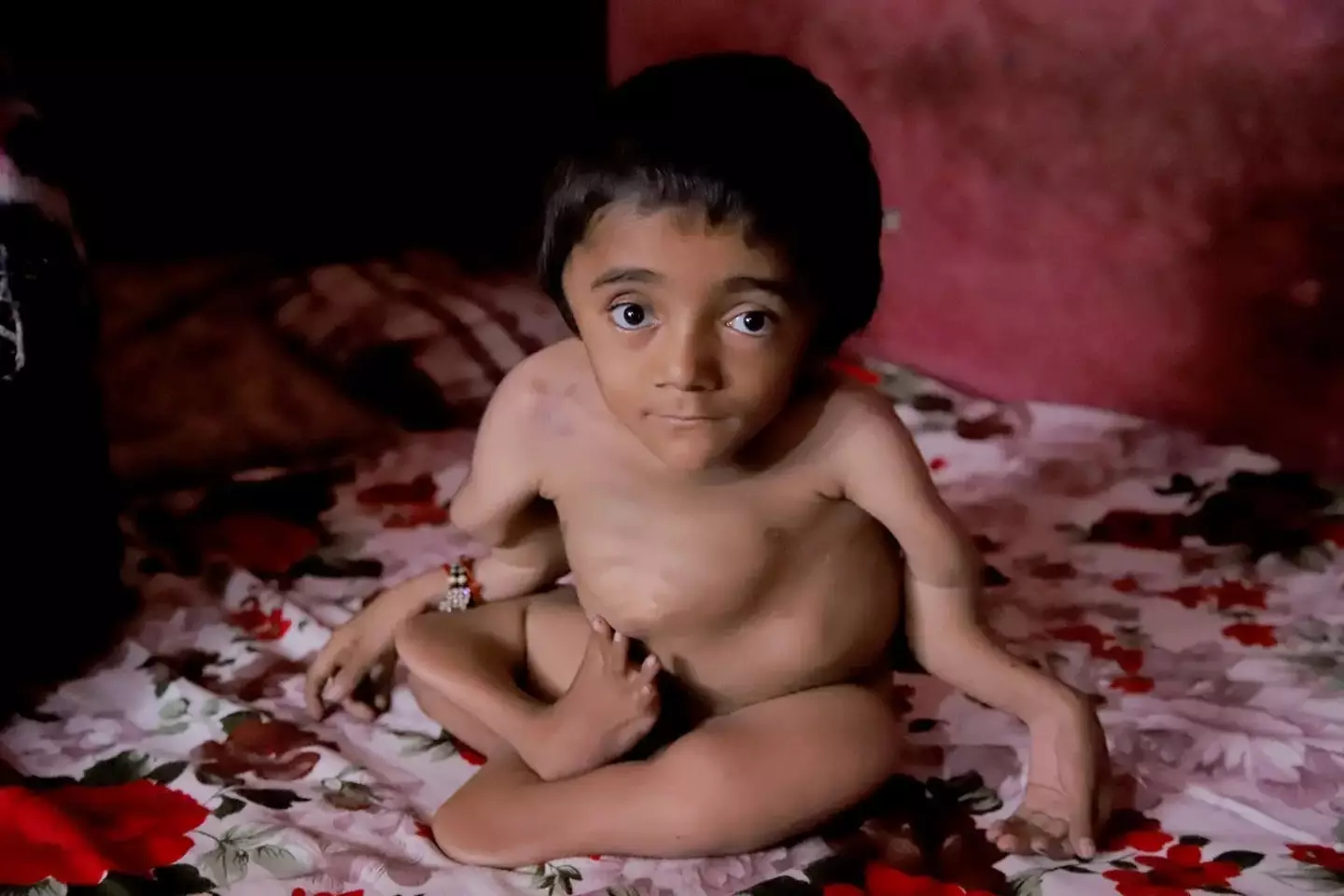12-year-old Rohit suffers from osteogenesis imperfecta.