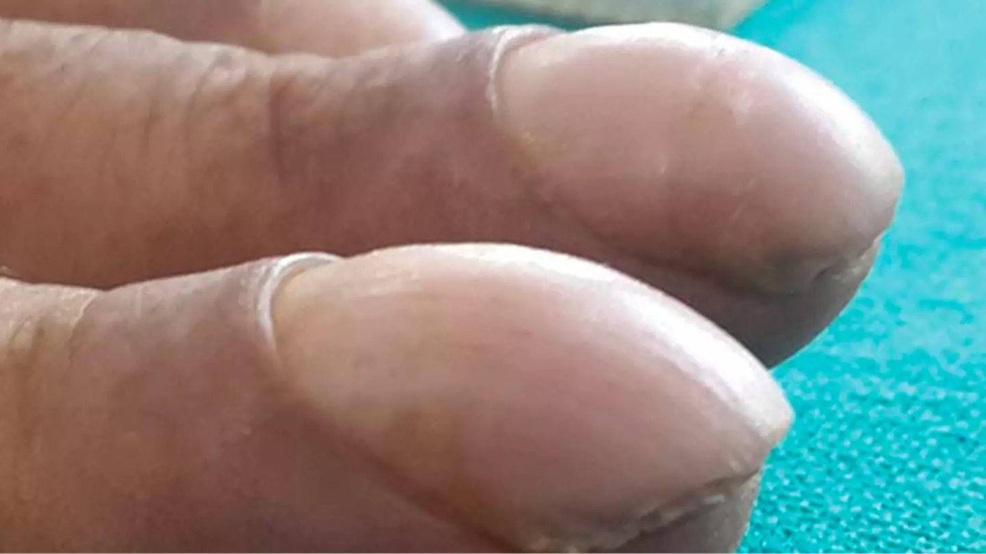 'Clubbing' explained as major change to finger could be sign of deadly disease