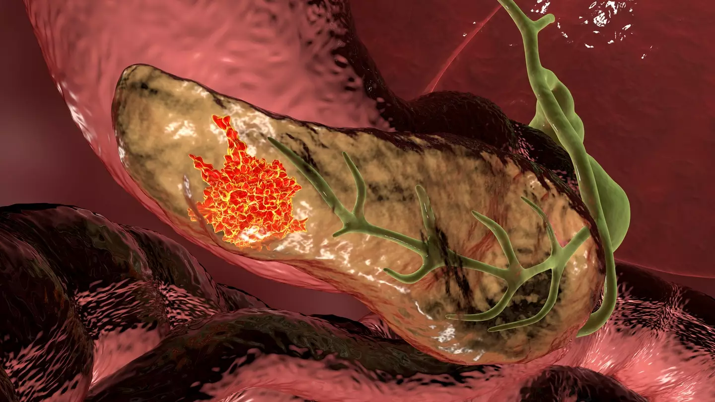 Pancreatic cancer is considered one of the most painful types (Getty Images)