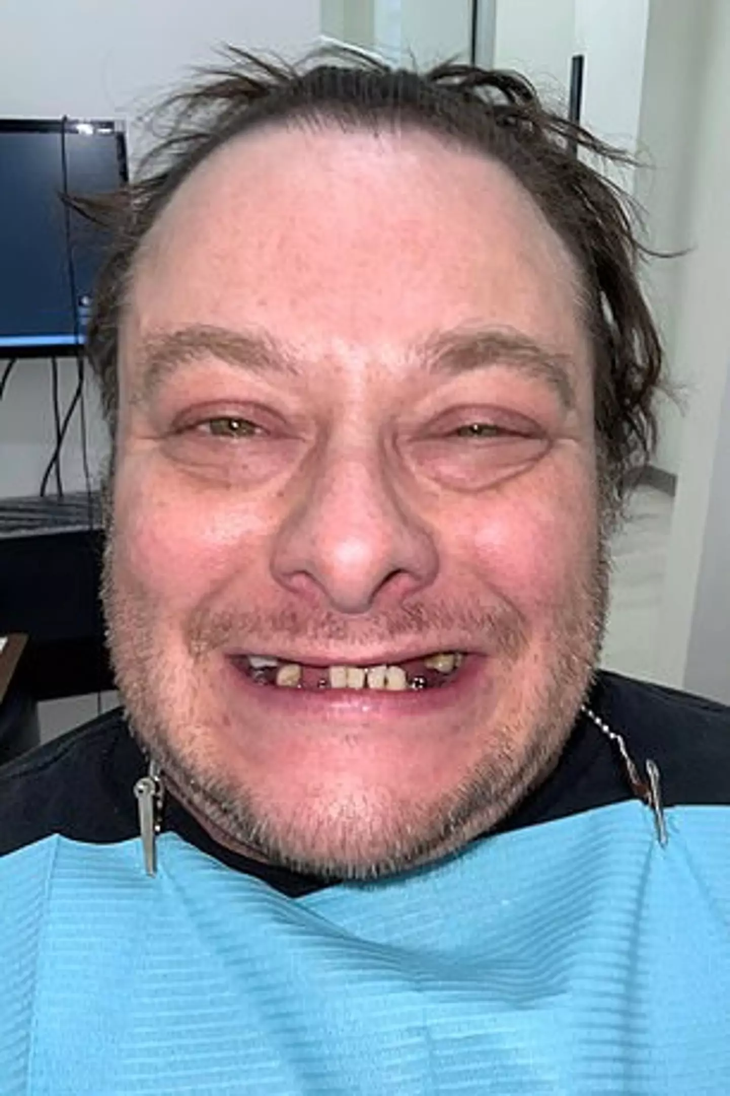 Furlong's teeth rotted and fell out due to years of meth use.