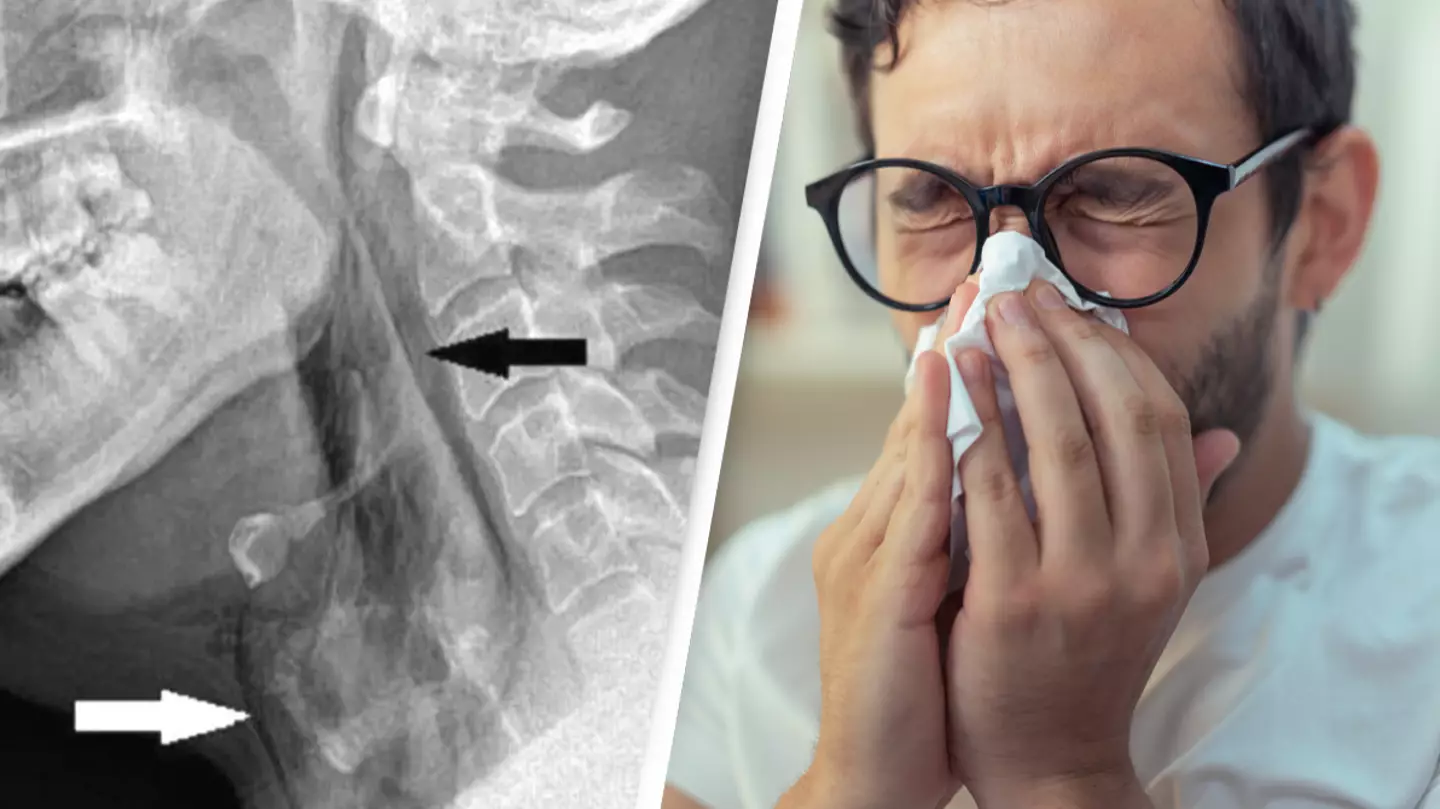 Man tears windpipe trying to hold in sneeze in first case of its kind