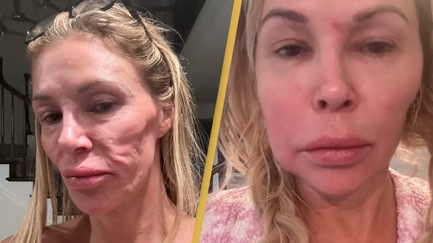 Brandi Glanville reveals most 'painful' part of 'parasite' that's caused her to lose five teeth and $70,000
