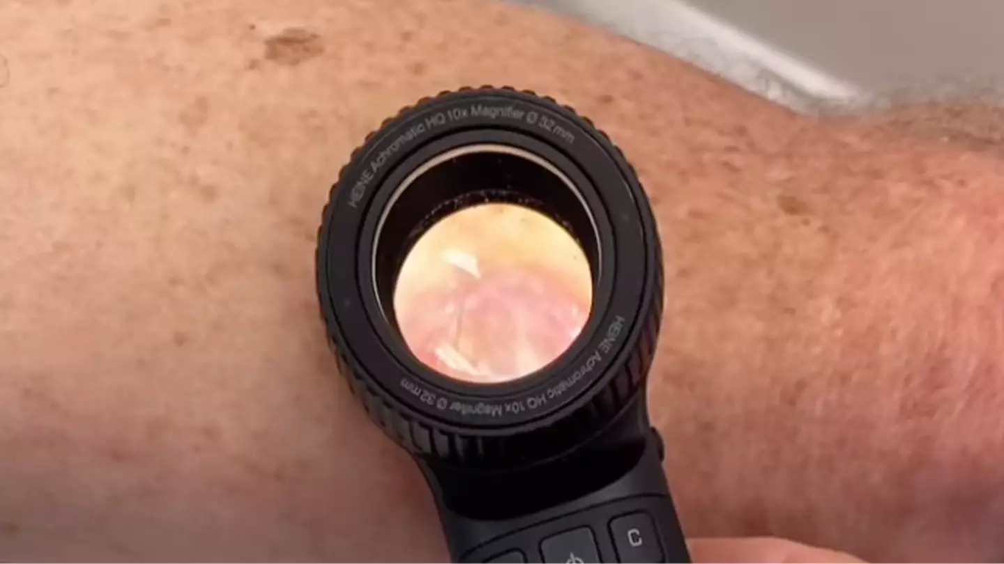 Doctor shares shocking video of 'worst' skin cancer he's ever seen and issues urgent warning
