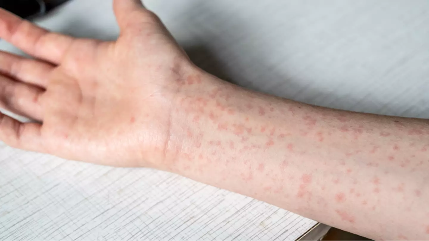 Health officials release shocking update after major measles outbreak in one US state