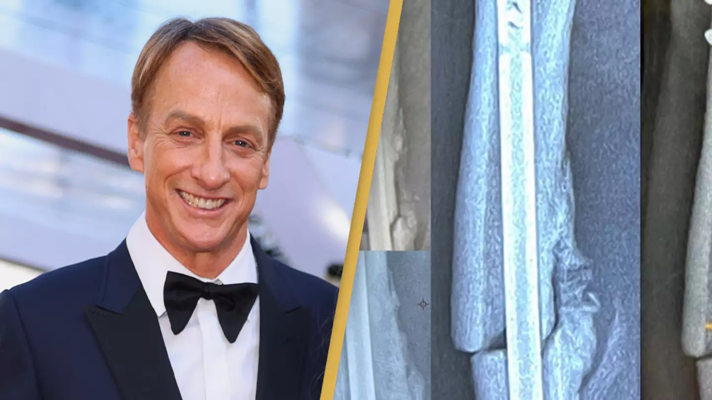 Tony Hawk gives painful update on future of skateboarding after breaking femur