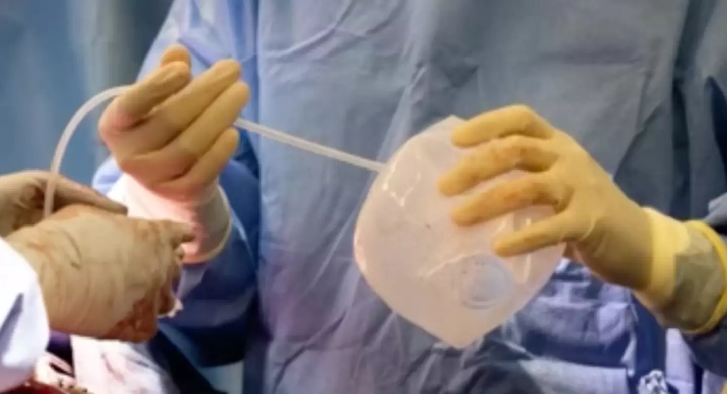 The implants helped support Bauer's heart.