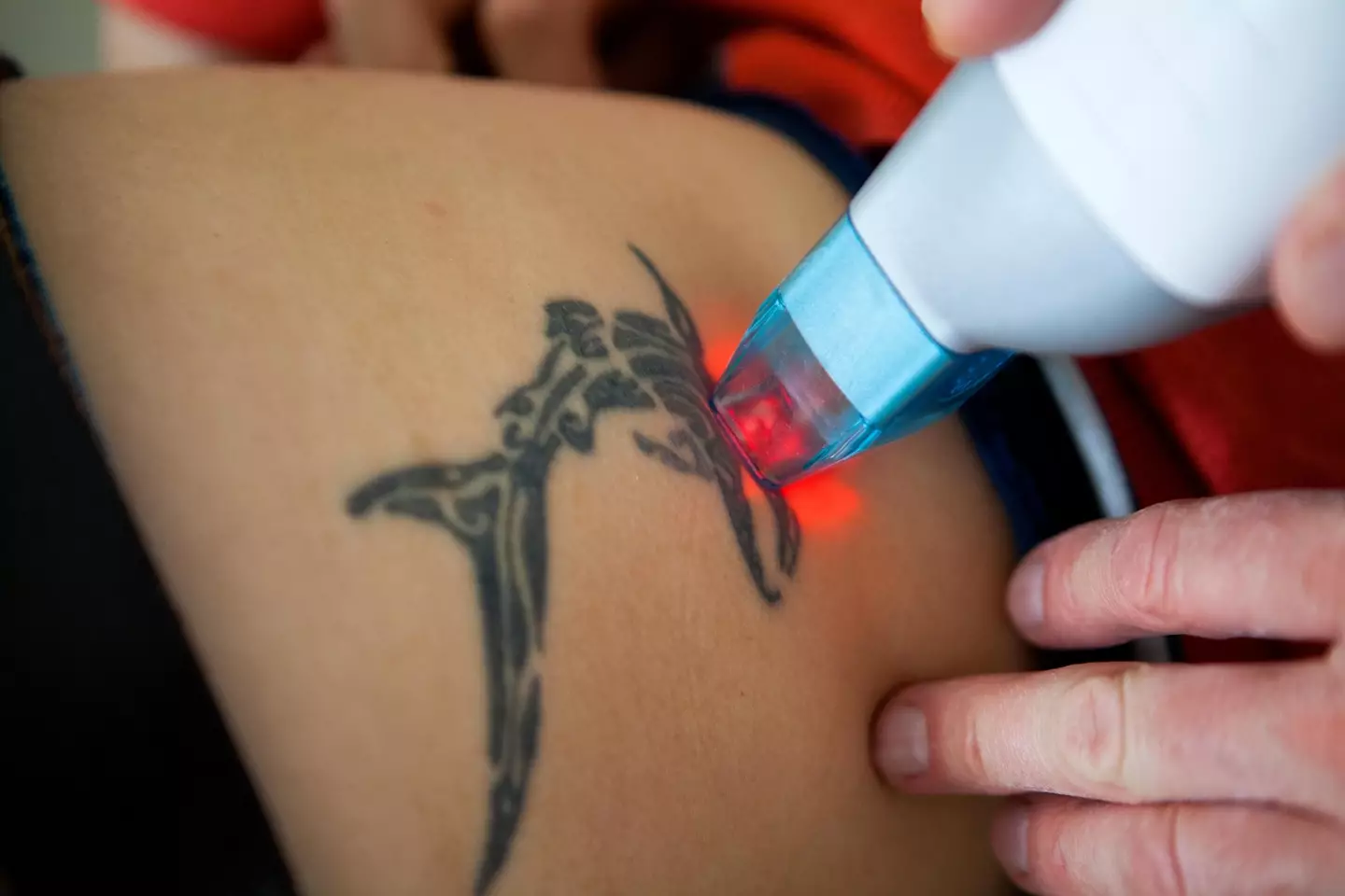 The laser is only one aspect of the tattoo removal process.