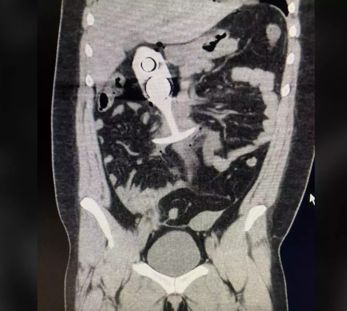 A scan showing someone with a butt plug inside them (Reddit)