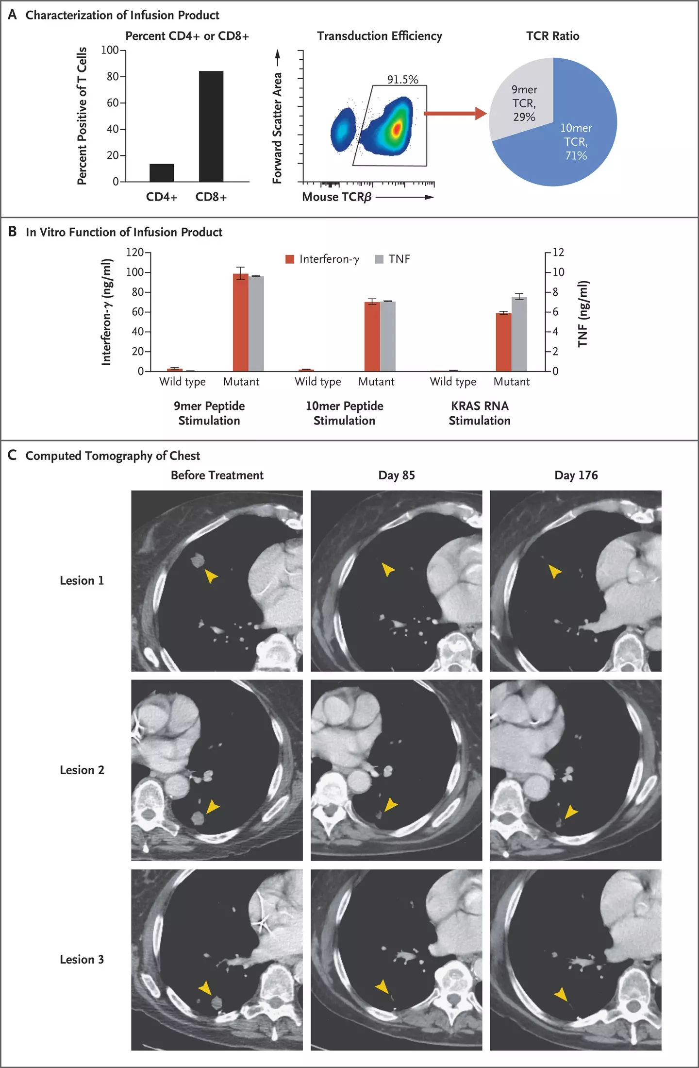 A CT scan of Wilkes' tumour before and after treatment.