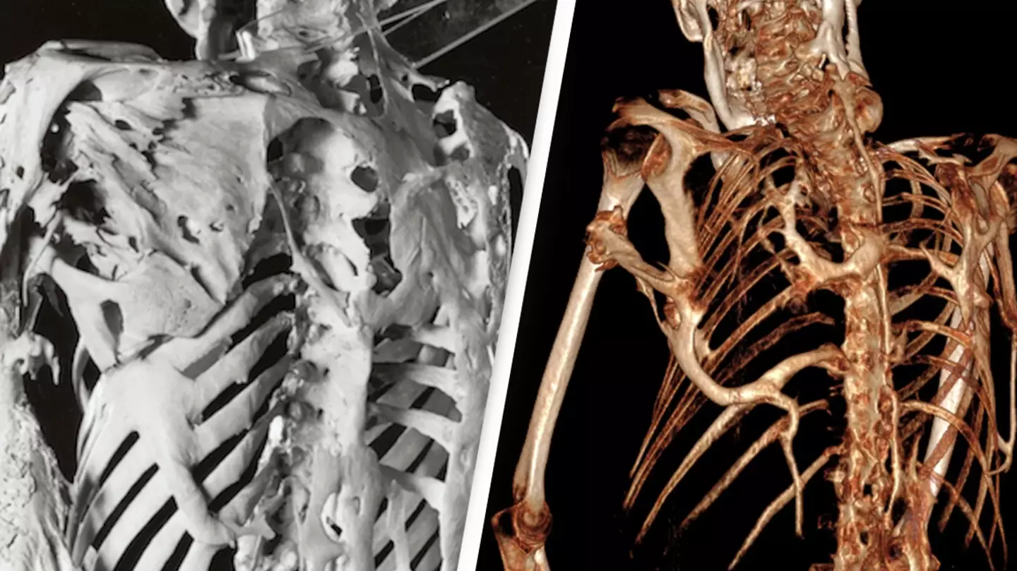 Incredibly rare disease ‘Stoneman syndrome’ turns muscles into bones