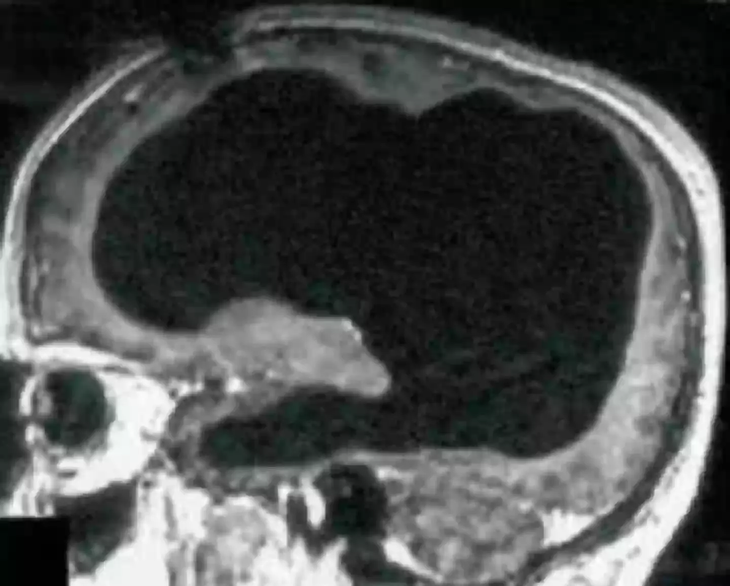The scan should show the man's brain... except most of it is missing. (Feuillet et al./The Lancet)