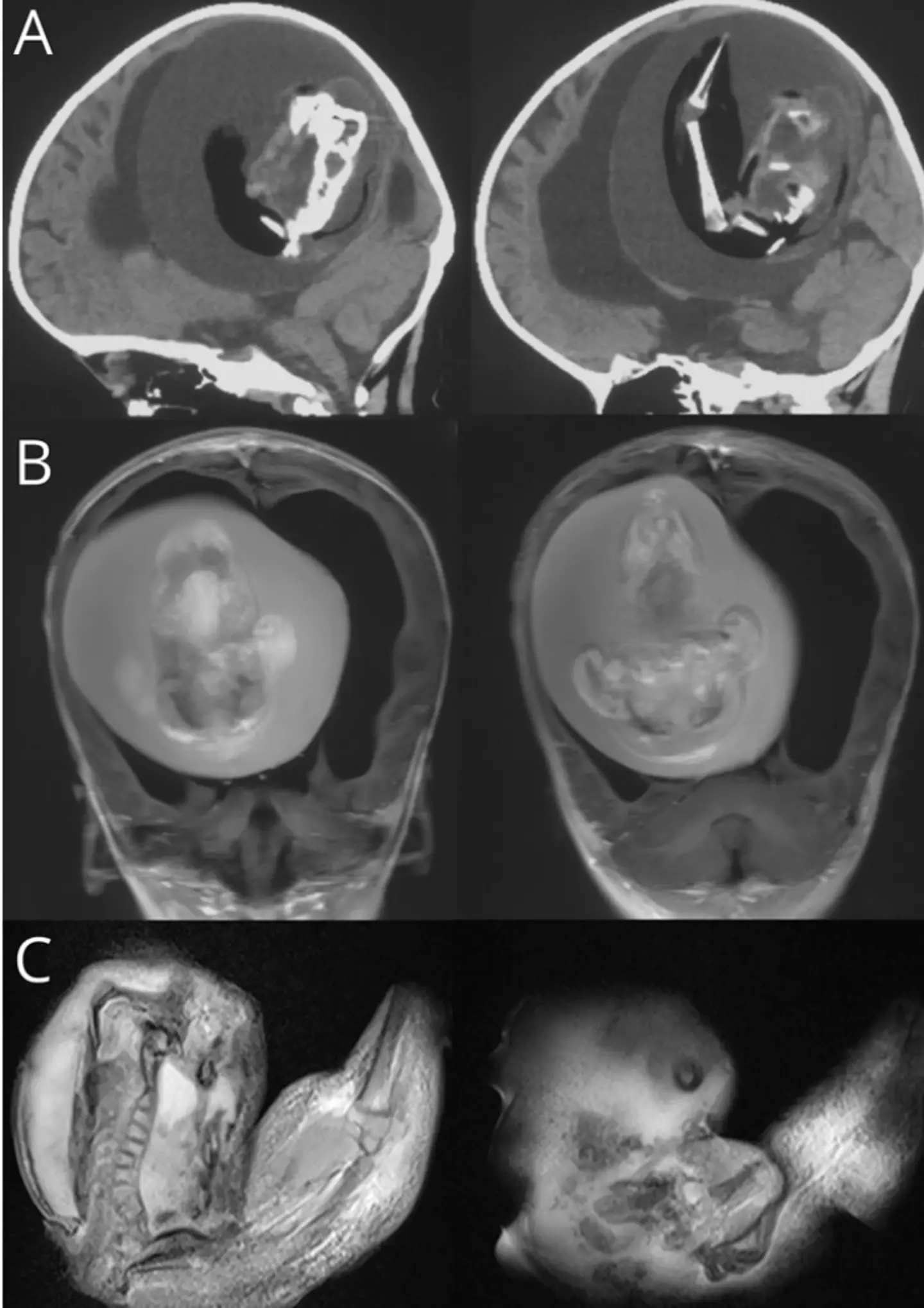 The head CT scan of the one-year-old (Neurology Journals/ Zongze Li et al)