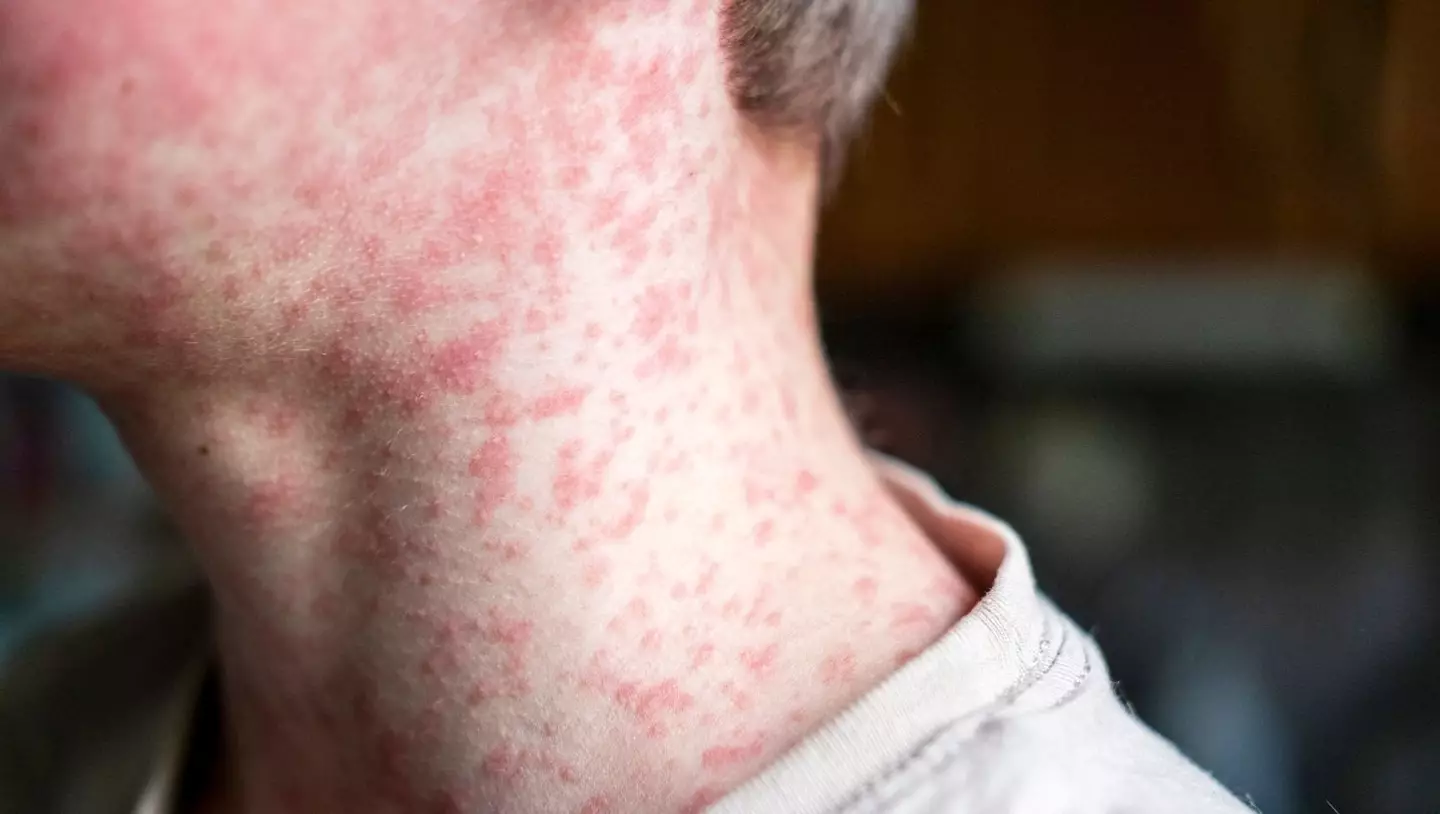 Experts have issued fresh information on the Utah measles outbreak (Getty Stock Image)