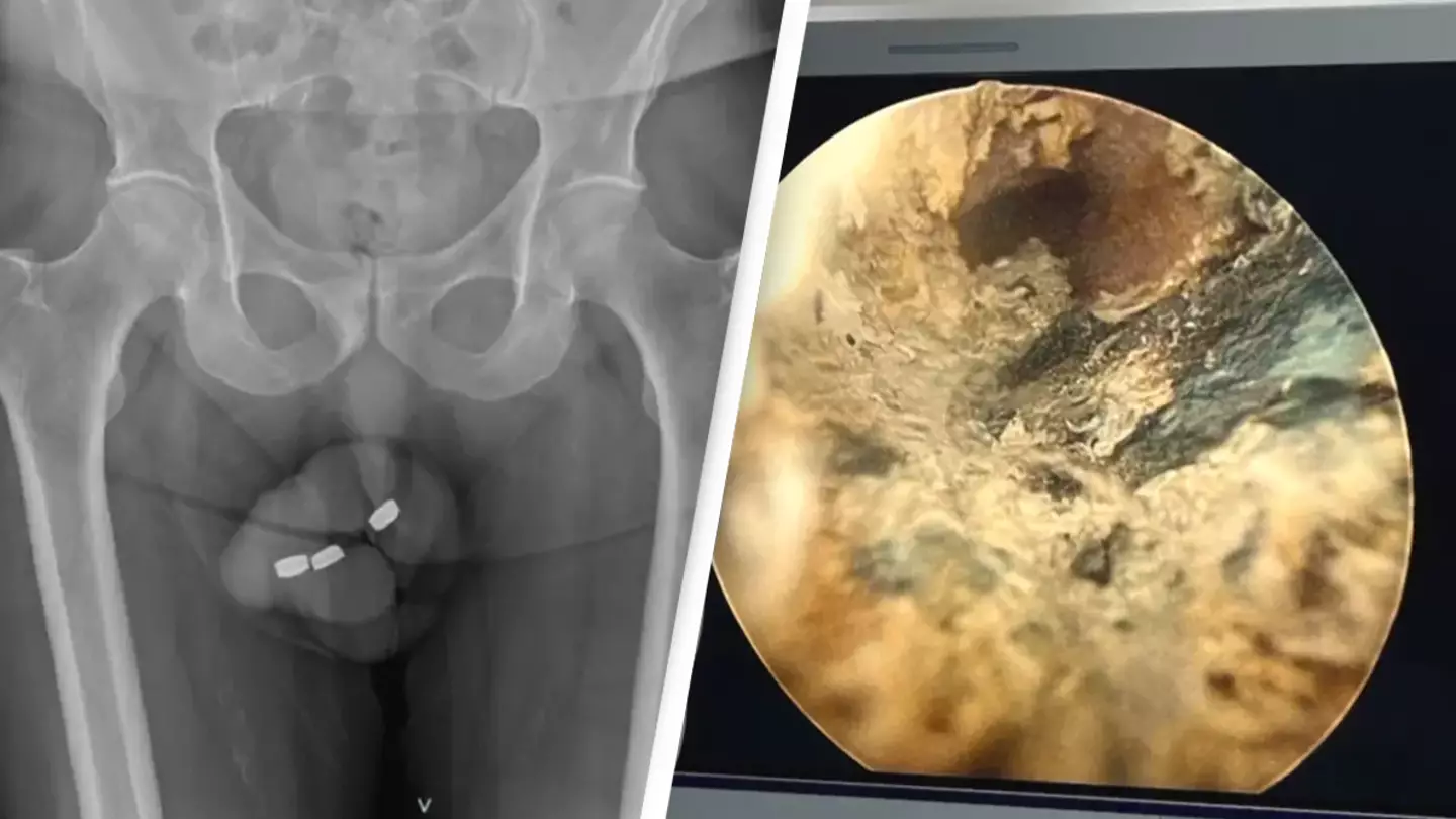 Man who shoved batteries into his penis forced to have surgery after getting them stuck