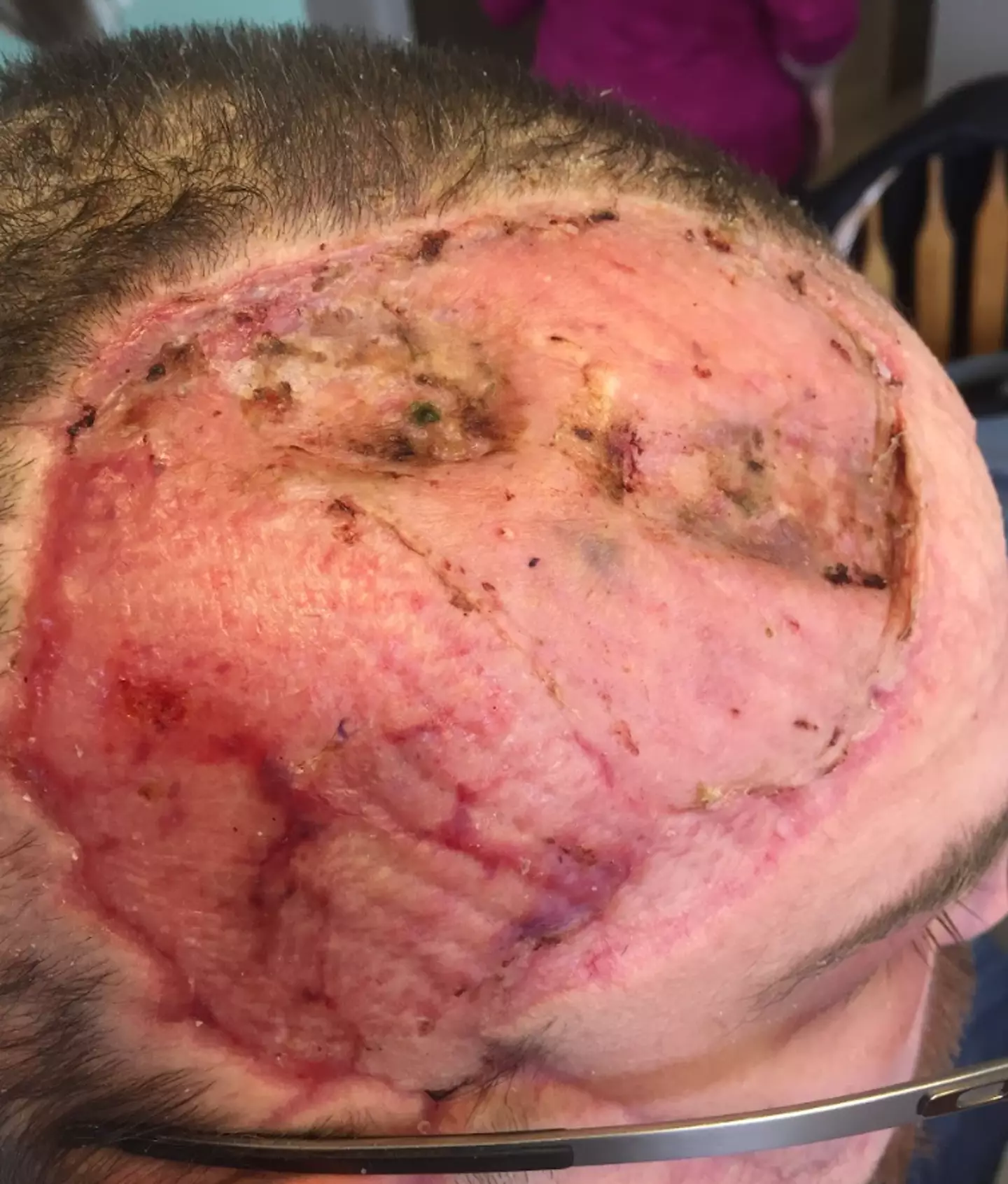 The bear tore at Jeremy's scalp.