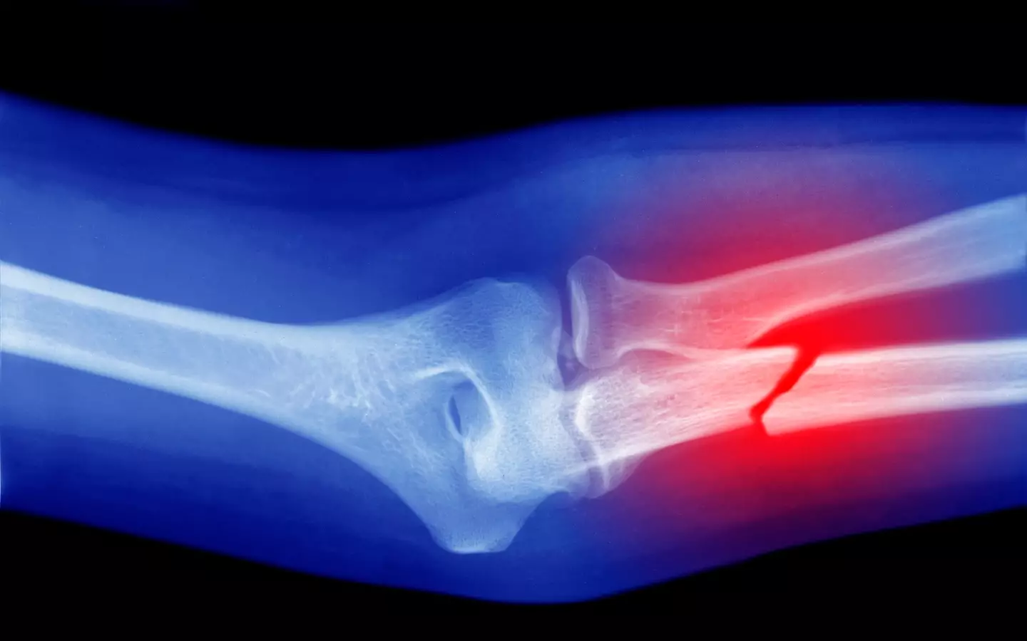 People with osteoporosis are more likely to suffer broken bones (Getty Stock Images)