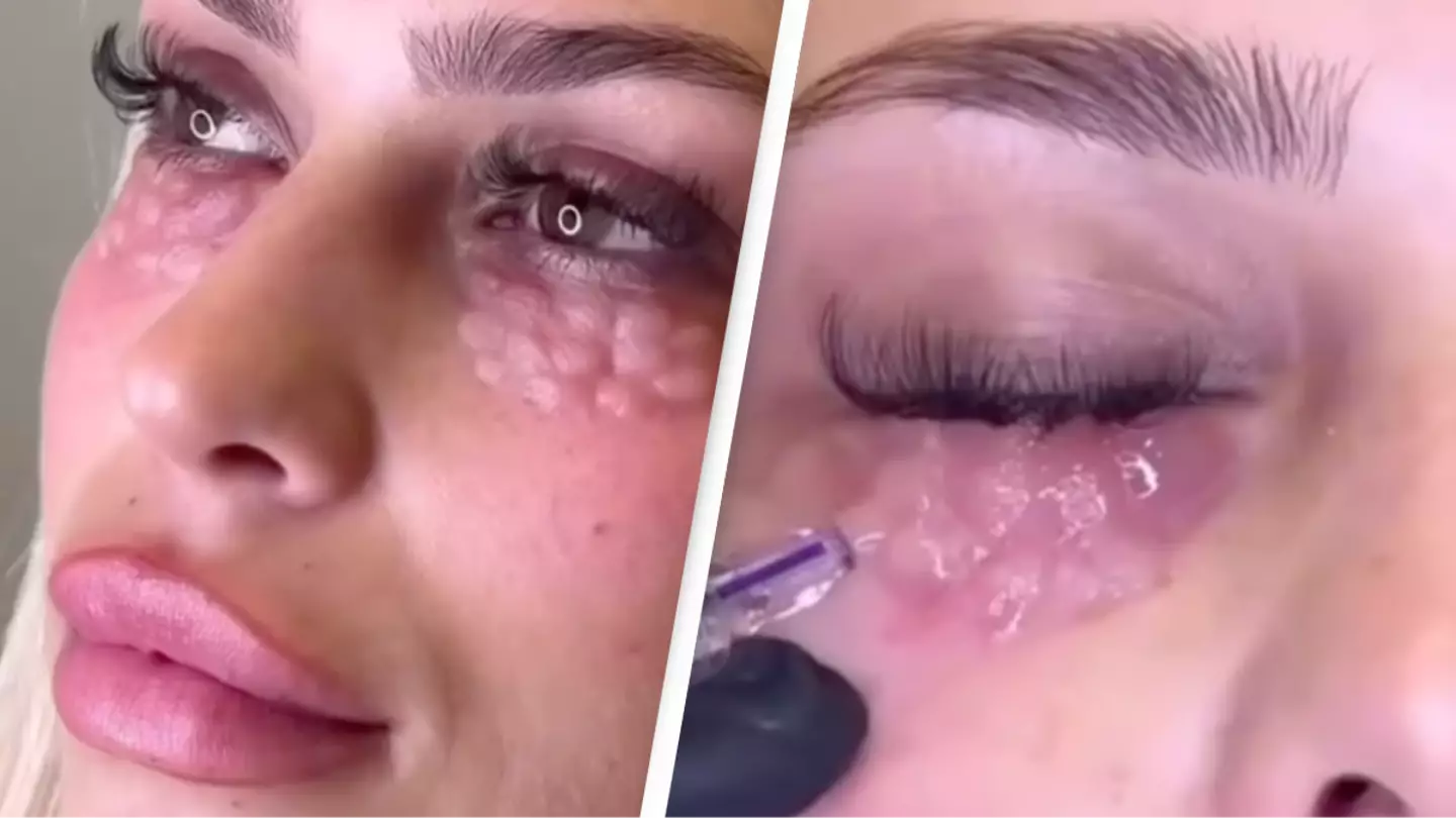 Doctors warn about permanent damage caused by new beauty trend that leaves people looking like reptiles