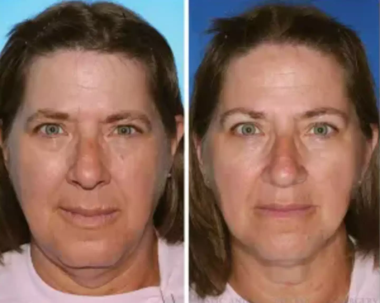 The twin on the left had smoked more than two decades longer than her sister (American Society of Plastic Surgeons)