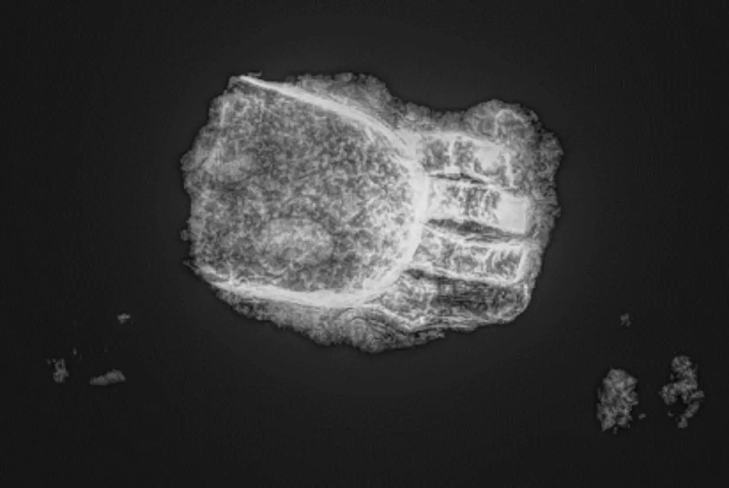 The owner of the prosthetic had their fingers amputated.