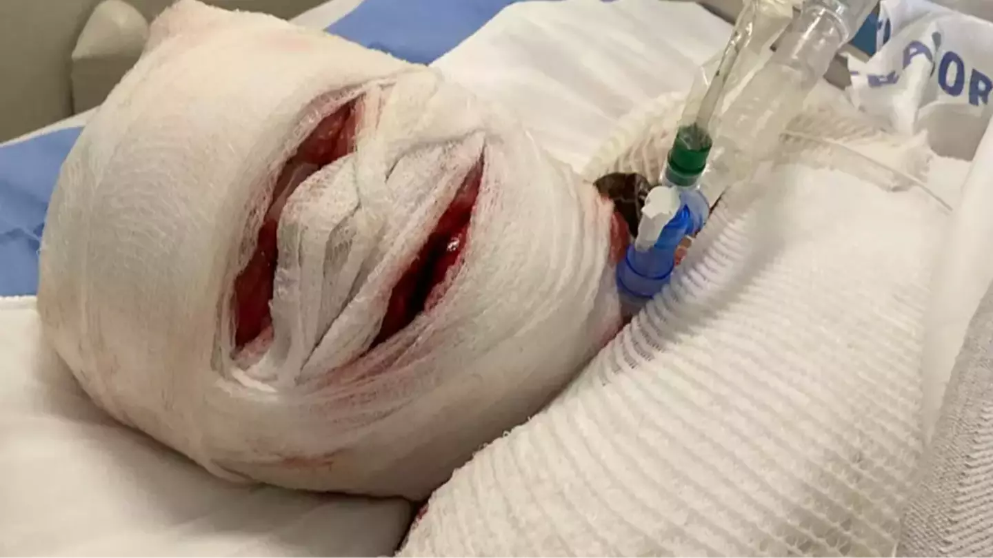 Rare condition explained after woman was left in a coma and face 'fell off' following reaction to Ibuprofen