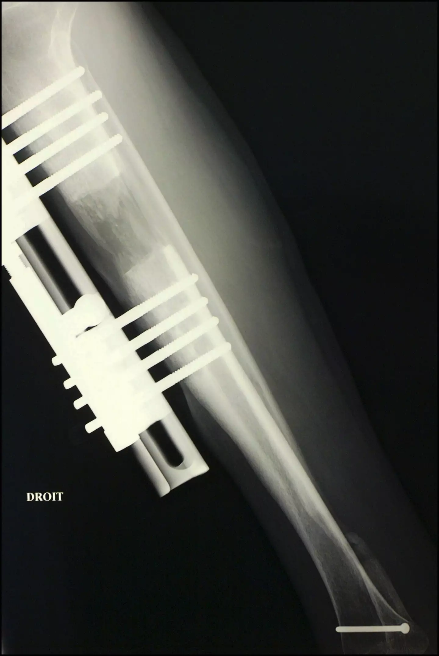 The procedure involves breaking the bones before 'stretching' them as they heal.