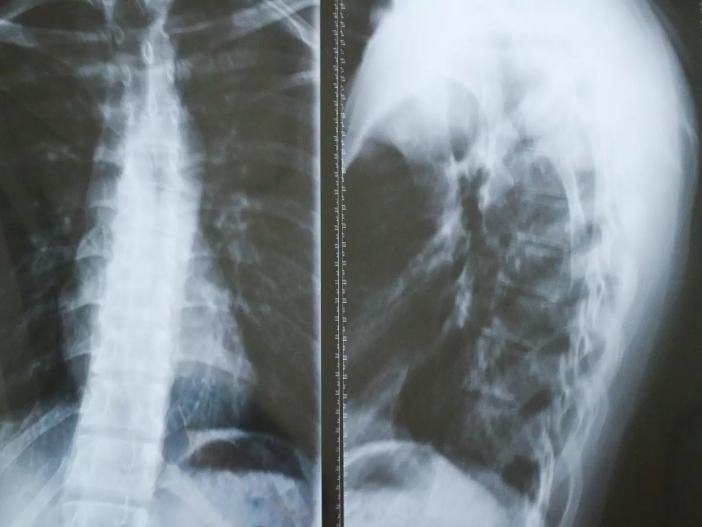 Gorham-Stout Syndrome has left experts baffled (Getty Stock Image)