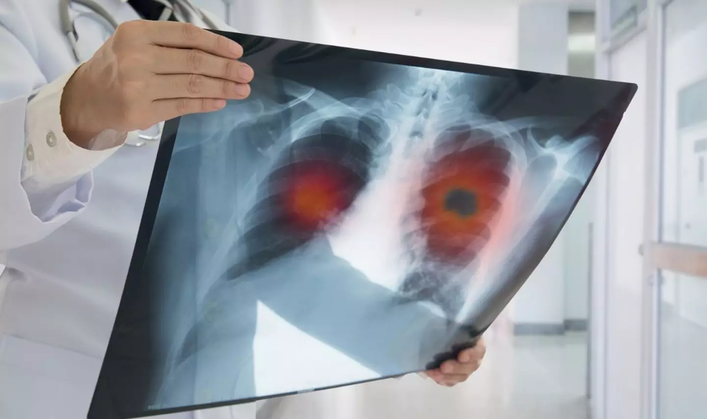 Researchers believe non-smokers are being diagnosed with lung cancer due to increased air pollution (Getty Stock Image)