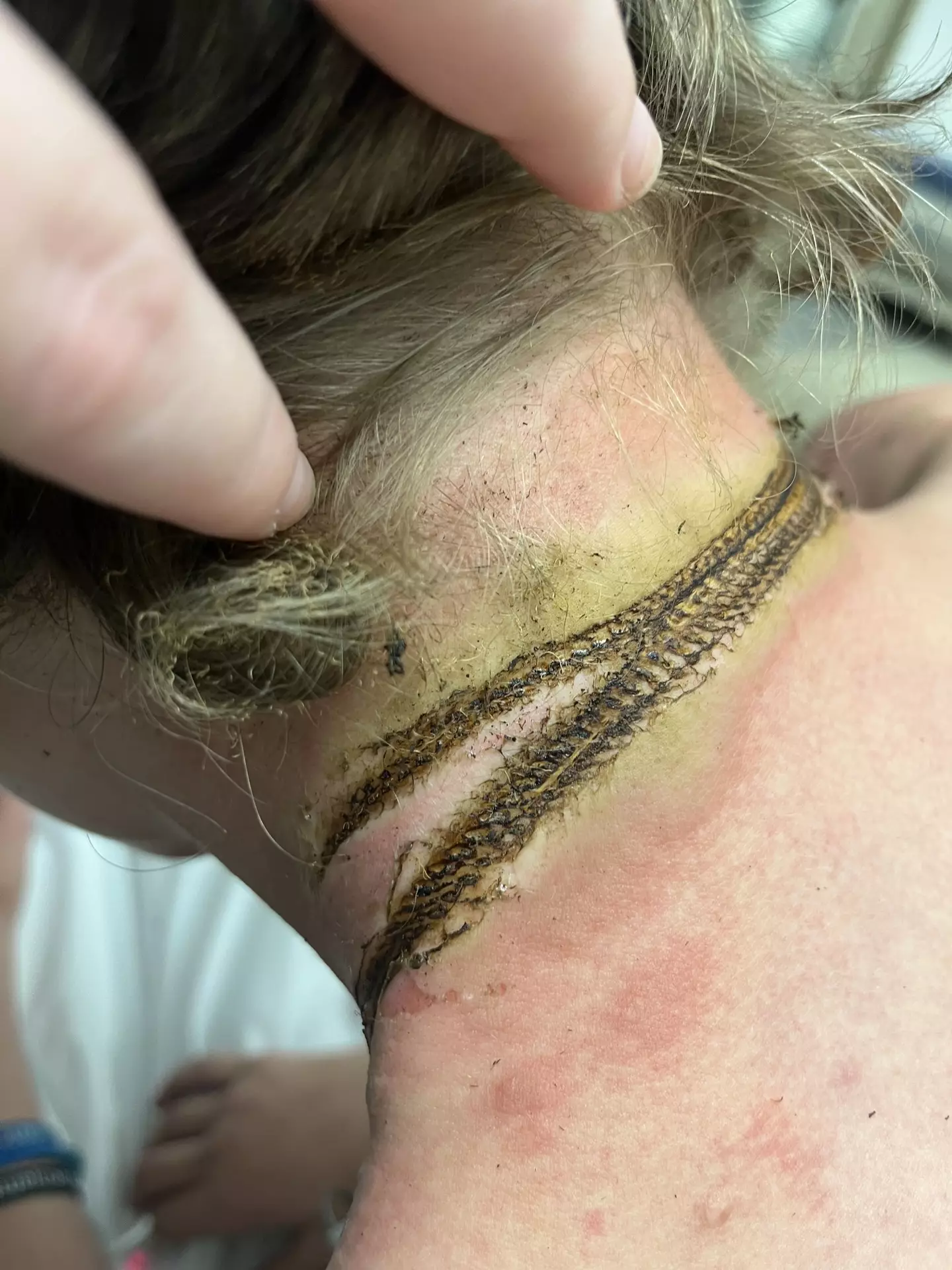 Rayce suffered severe burns (Kennedy)