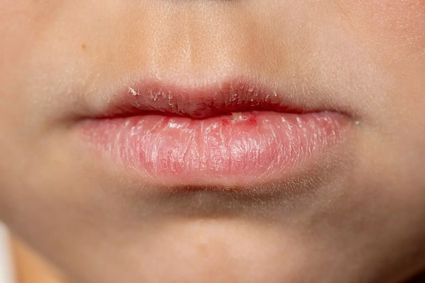 Chapped lips can be irritating and uncomfortable (Tatiana Cheremukhina/Getty)