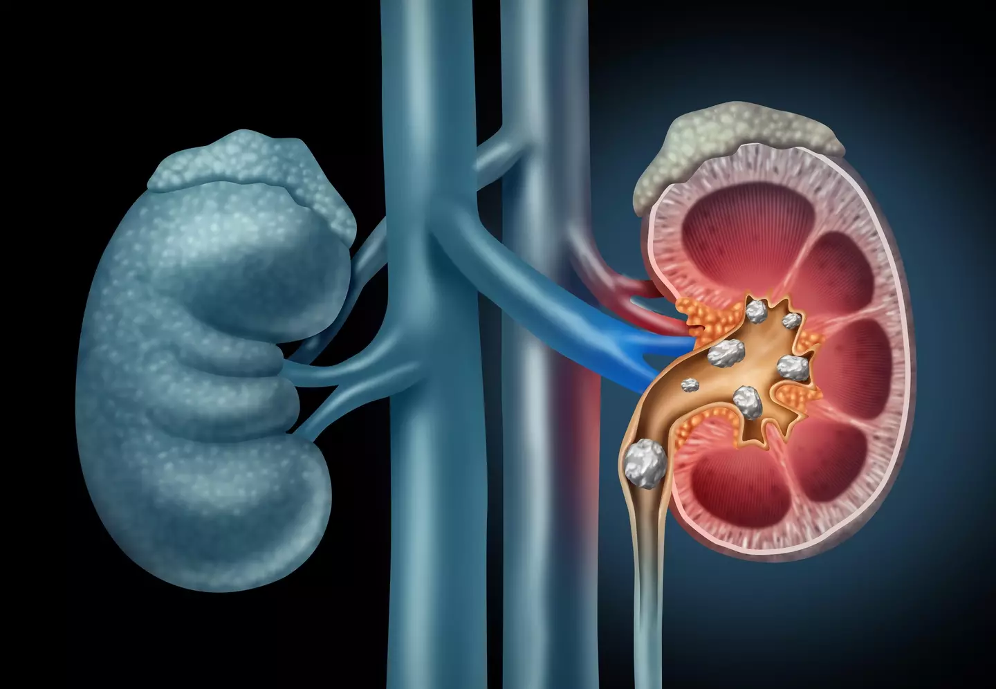 1 in 10 people in the UK are affected by kidney stones.