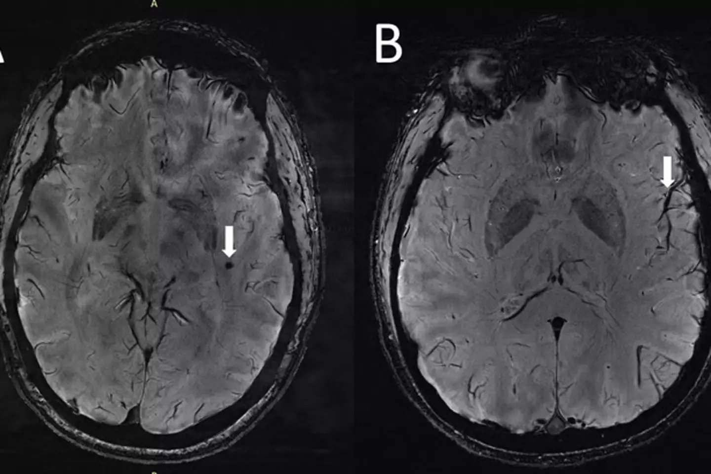 That spot on the left is a cranial microbleed, while the thing on the right is an example of an enlarged perivascular space.