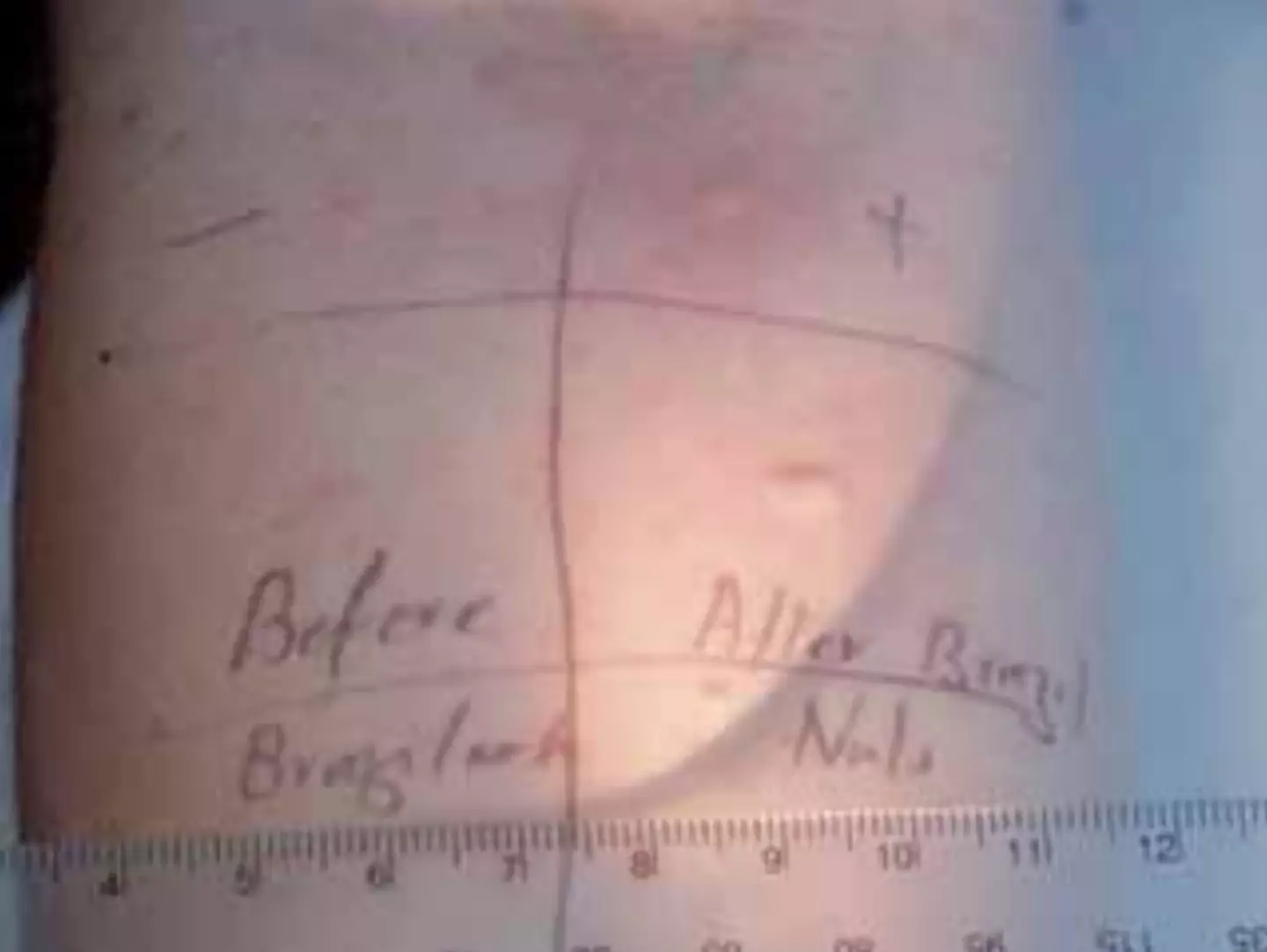 Skin prick testing with partner’s semen before and after he had consumed four Brazil nuts (AS Bansal, R Chee, V Nagendran, A Warner, G Hayman)