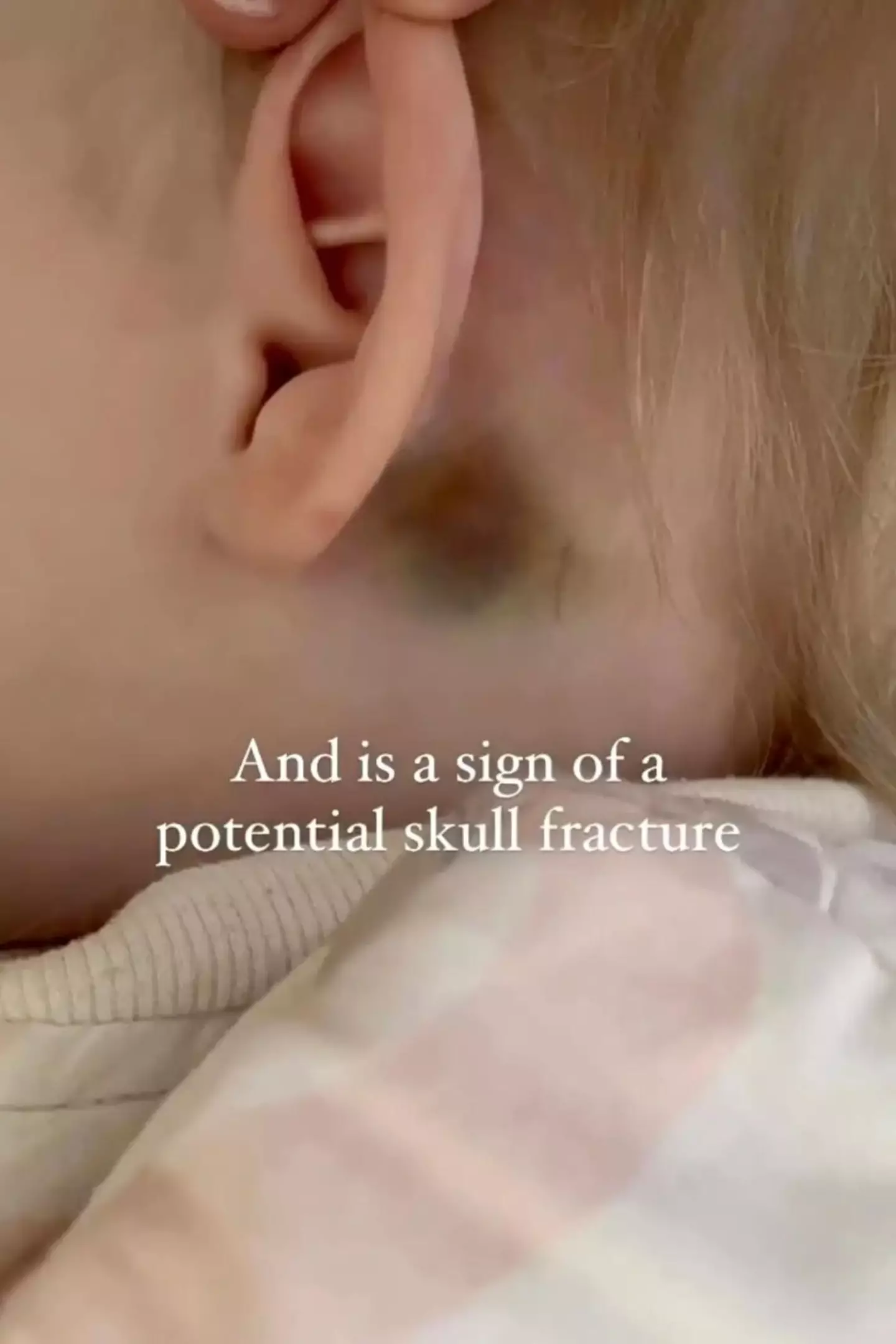 Parents are being advised to look out for bruises on their child's head. (Instagram/@tinyheartseducation)