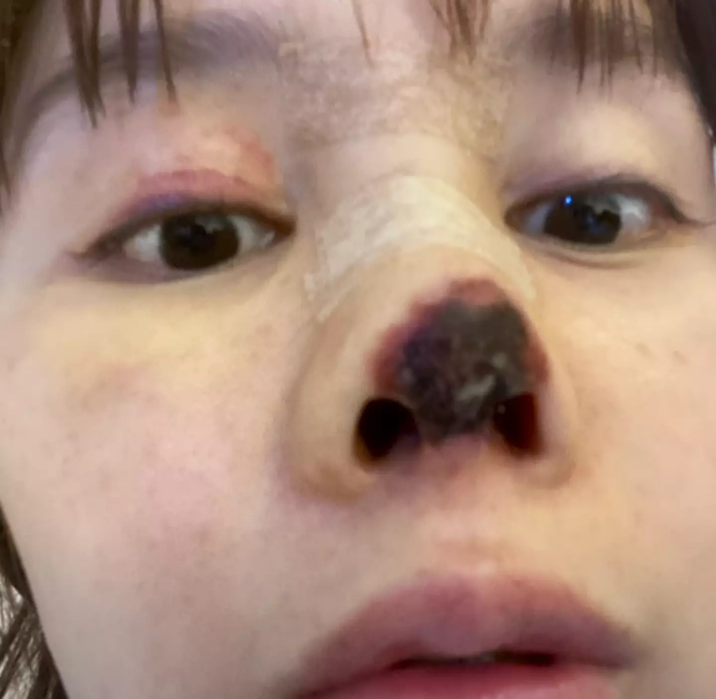 The end of Liu's nose had 'died' (BBC World Service)